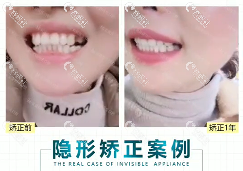广州中家医家庭医生口腔医院牙齿矫正隐形矫正日记