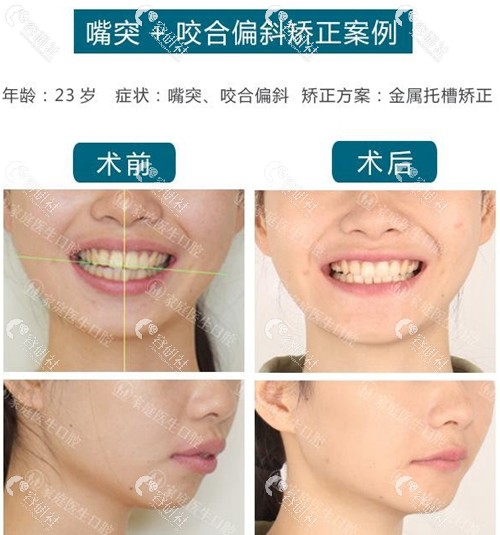 广州中家医家庭医生口腔医院牙齿矫术后效果