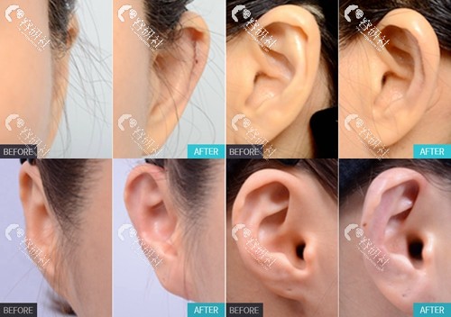 使用捐赠肋骨做贴发耳矫正手术效果图