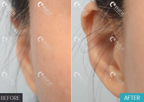 profile普罗菲耳整形外科贴发耳矫正手术案例