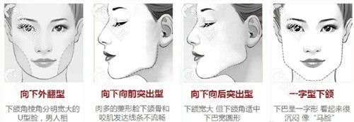 上海伊莱美李湘原下颌角磨骨类型
