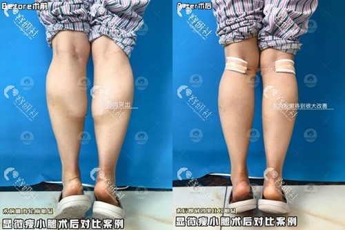 上海丽质卢九宁显微瘦小腿前后对比图