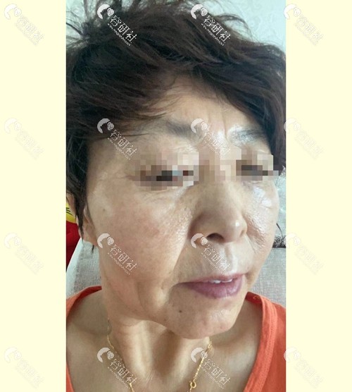西美（西京）整形外科超皮秒祛斑术后效果照片