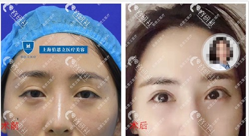 上海伯思立医院双眼皮修复日记对比