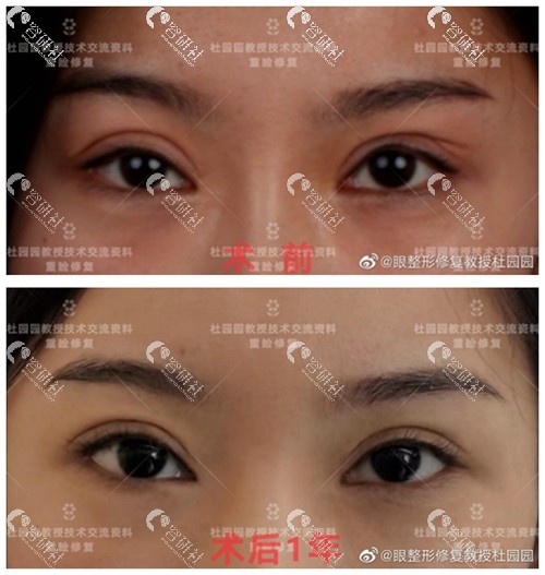 上海美莱杜园园医生双眼皮修复日记