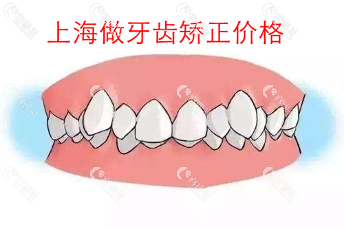 上海做牙齿矫正价格是多少