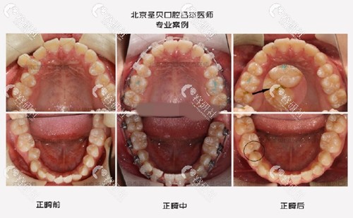 北京圣贝口腔门诊部牙齿矫正前后效果对比