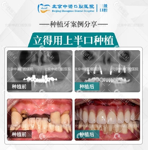 北京中诺口腔种植牙前后效果对比