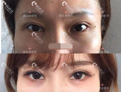 北京丽星翼美医疗美容魏志香双眼皮修复案例