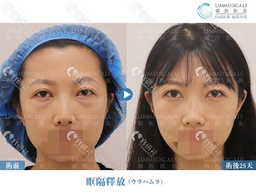 北京领医医疗美容门诊部双眼皮修复前后效果对比