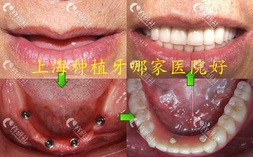 上海种植牙医院哪家好？上海种植牙医院排名前十名单