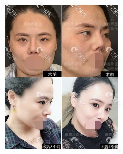 北京柏丽医疗美容门诊部李劲良鼻综合前后效果对比