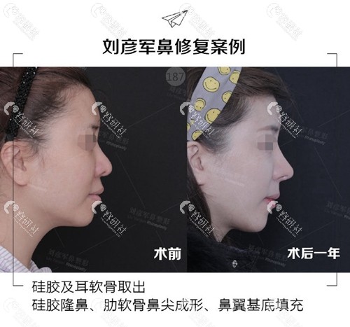 北京沃尔医疗美容诊所刘彦军鼻修复日记