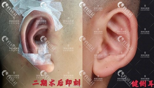 郭树忠全包法耳再造二期术后即刻和健侧耳对比图
