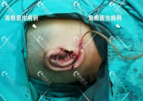 北京八大处周栩做耳再造术后即刻图