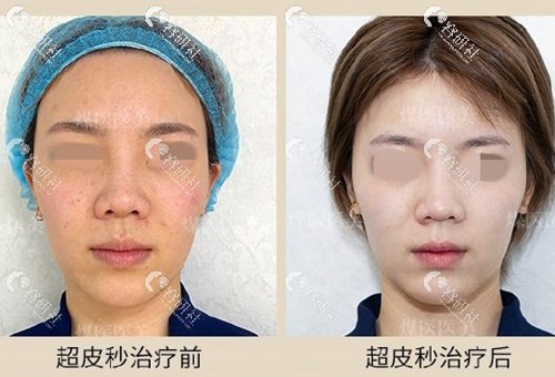 北京煤医医疗美容医院超皮秒祛斑前后效果对比照片