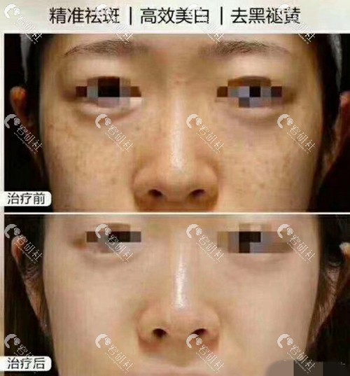 北京画美医疗美容医院超皮秒祛斑前后效果对比照片