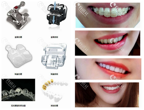 牙齿矫正不同牙套种类