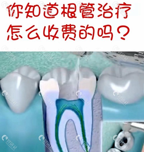 上海根管治疗一颗牙多少钱？