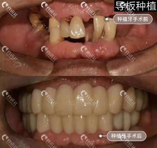 吉林长春环球口腔医院种植牙前后效果对比照片