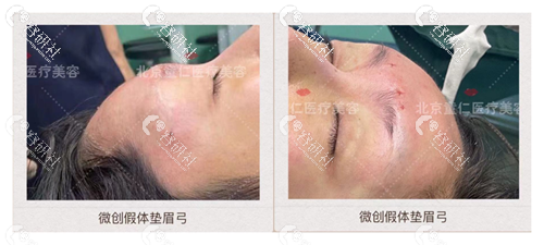 北京童仁欧素娇医生假体垫眉弓前后效果对比照片
