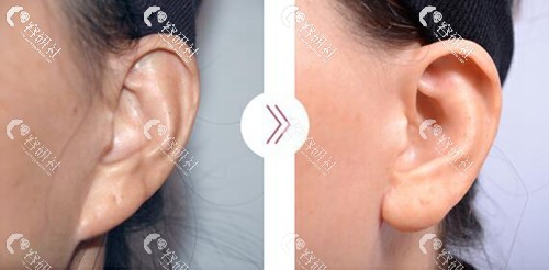 玻尿酸填充耳垂图片