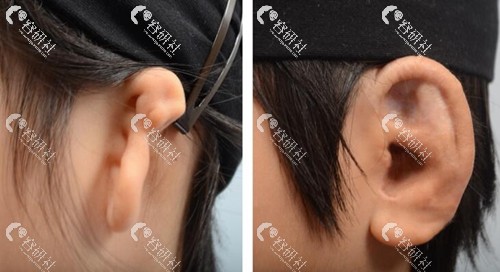 使用肋软骨做耳畸形矫正手术失败后，还能修复吗？