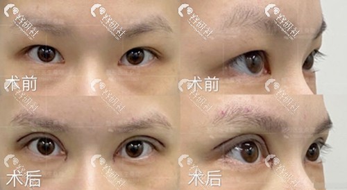西安目秀医疗美容桑璇拉双眼皮术前和术后变化