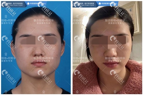 北京联合丽格何照华下颌角截骨前后效果对比照片