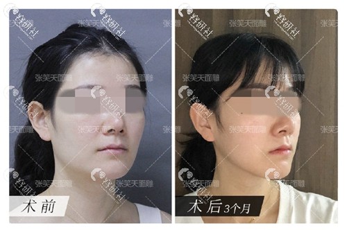 北京圣嘉新医疗美容医院张笑天下颌角磨骨前后效果对比
