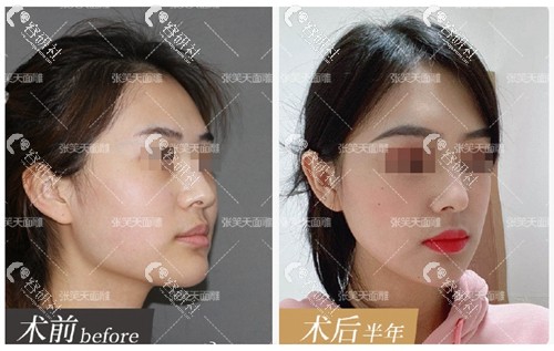 北京圣嘉新医疗美容医院张笑天下颌角长曲线截骨前后对比照片