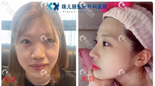 韩国珠儿丽医院鼻综合案例对比图