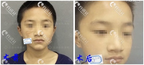 上海虹桥医院疤痕科做激光去疤痕日记对比图片