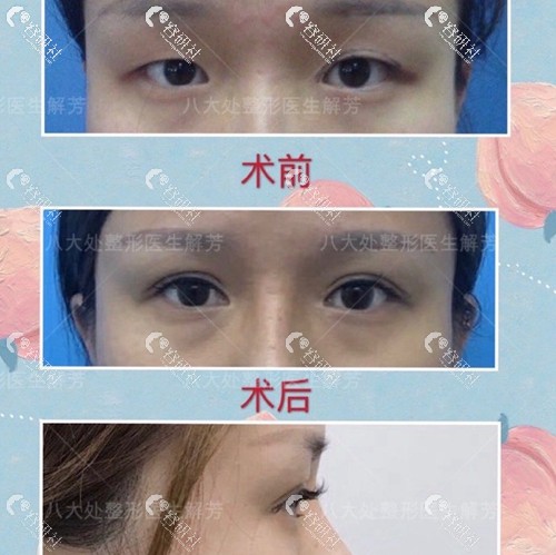 北京八大处眼解芳医生割双眼皮前后效果对比