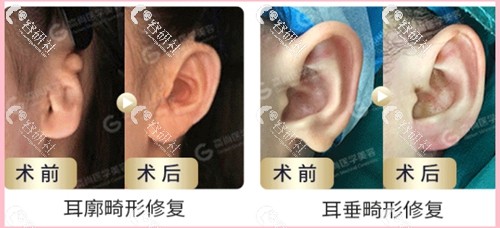 广州高尚医学美容耳廓/耳垂畸形修复日记