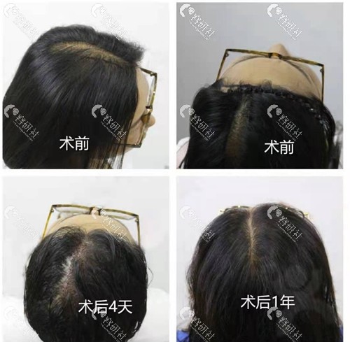 苏州雍禾植发头顶加密种植前后对比照片