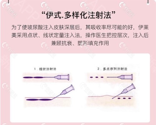 上海伊莱美医院玻尿酸丰唇注射方式示意图