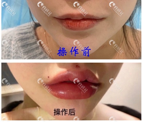 上海玫瑰医院玻尿酸丰唇日记对比效果图展示