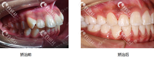 昆明长鹏口腔牙齿矫正前后对比