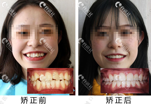 六盘水水城口腔牙齿矫正日记