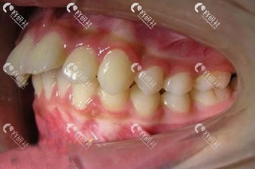 龅牙会发生遗传吗