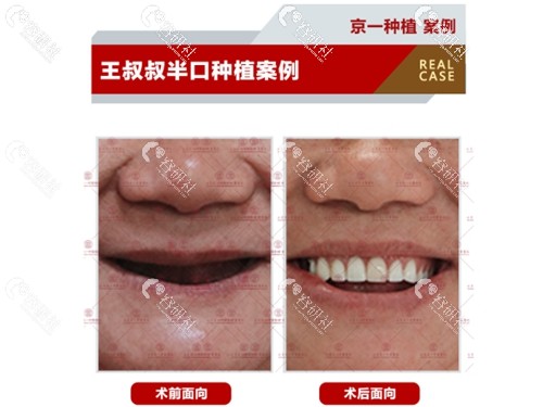 北京京一口腔医院种植牙前后对比照片