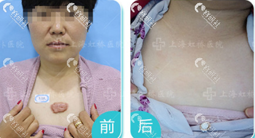 上海虹桥疤痕修复中心袪凸起疤痕前后对比日记