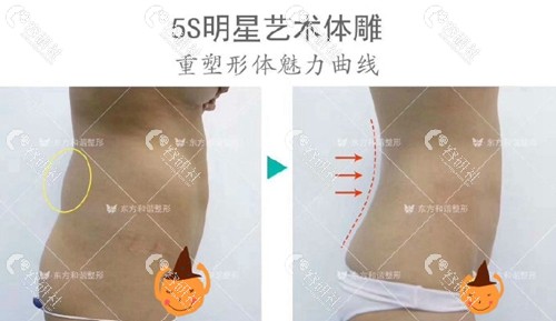 北京东方和谐医疗美容腰腹吸脂前后对比照片