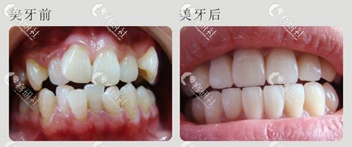 湛江南方口腔医院牙齿矫正对比照片
