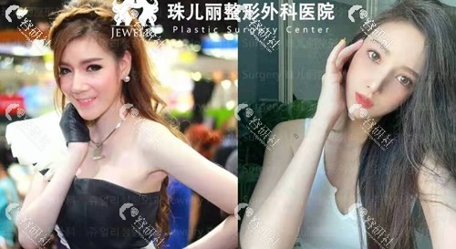 韩国珠儿丽眼鼻手术+颧骨缩小日记术前术后对比