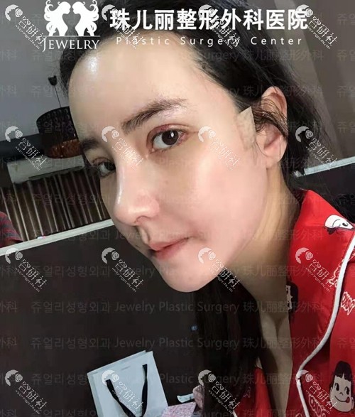 韩国珠儿丽眼鼻手术 颧骨缩小案例术后恢复照