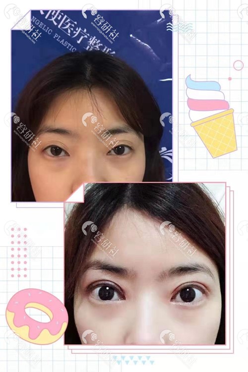 四川广元天使医疗美容医院割双眼皮前后对比照片