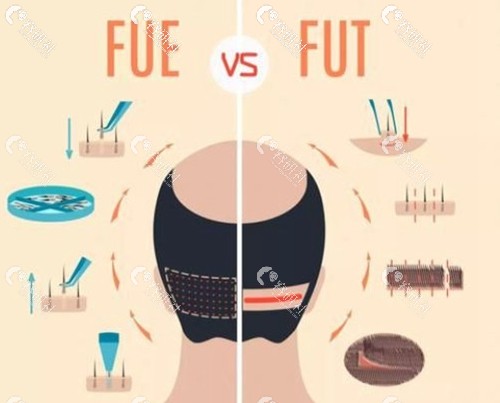 教你辨别植发FUE和FUT技术的区别