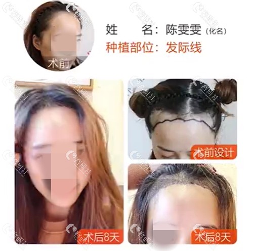 北京薇琳植发医院发际线种植前后对比图